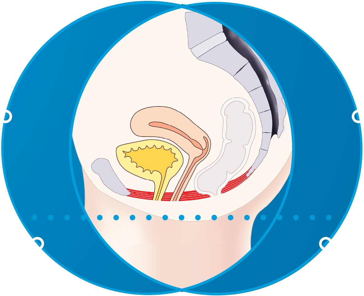EMFEMME 360 applicator
